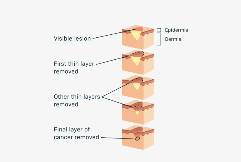 Mohs-surgery - Skin Cancer, transparent png download