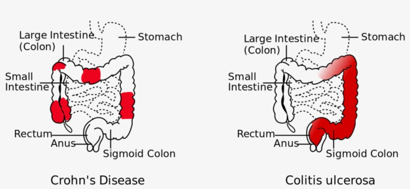 Crohn's Disease Vs Colitis Ulcerosa - Difference Between Crohns And Ulcerative Colitis, transparent png download