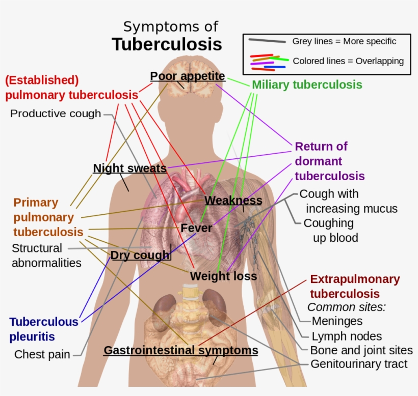 “symptoms Of Tuberculosis - Respiratory System Tuberculosis, transparent png download
