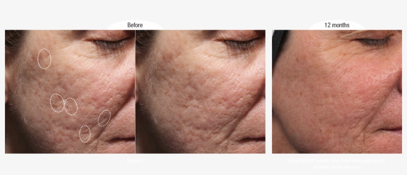 Before And Afters - Bellafill For Acne Scars, transparent png download