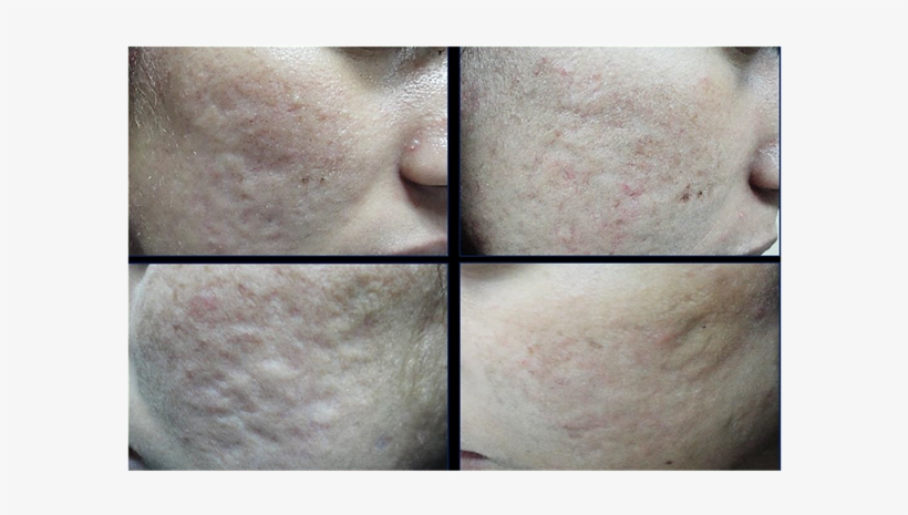 Patient With Rolling Acne Scar Before And Six Months - Freckle, transparent png download