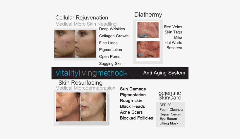 What Is The Best Treatment For Acne Scars - Diathermy And Acne, transparent png download