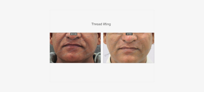Face Lifting - Rhytidectomy, transparent png download