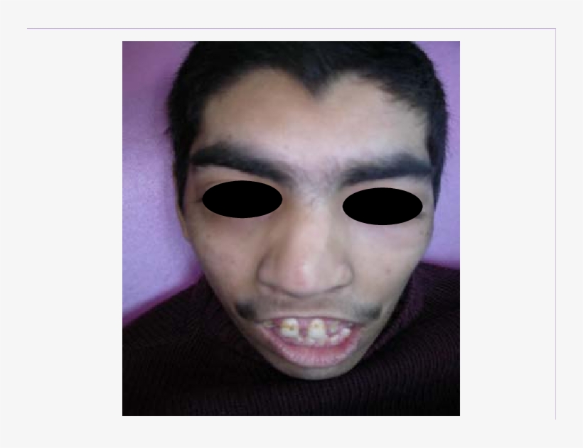 Patient's Facial Features, Which Include Arched Eyebrows - Unibrow, transparent png download