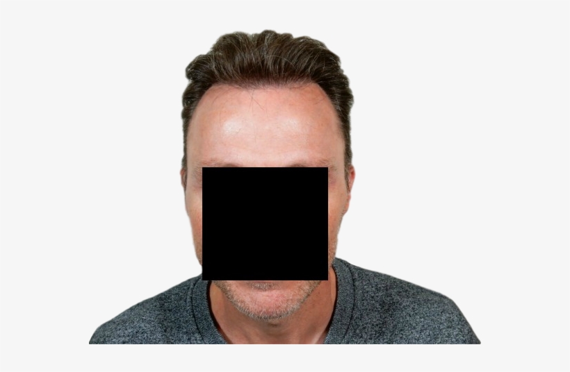 Fue Hair Transplantation - Smartphone, transparent png download