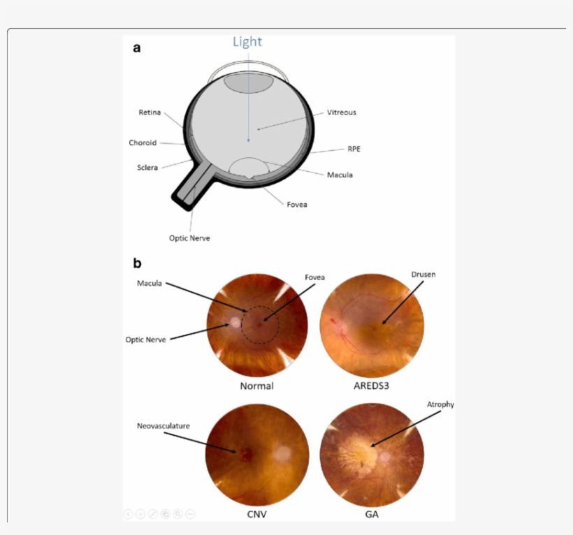 Progression Of Age-related Macular Degeneration - Fundus Photography, transparent png download