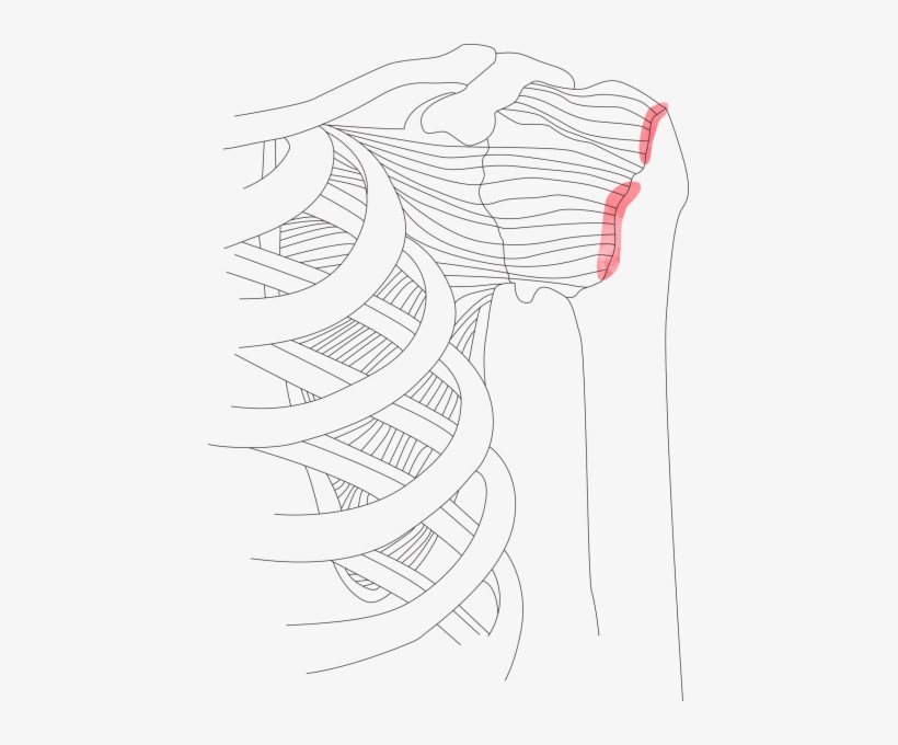 Rotator Cuff Tears May Be Partial Or Full Thickness - Rotator Cuff Tear, transparent png download