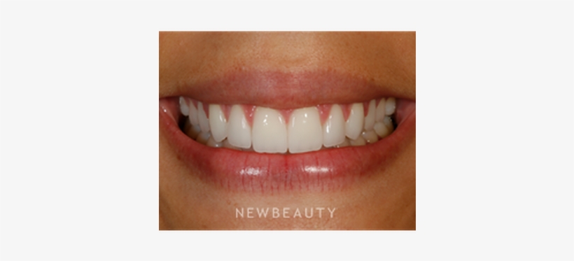 Dr Patrick Broome Gum Lift B - Gum Lift, transparent png download