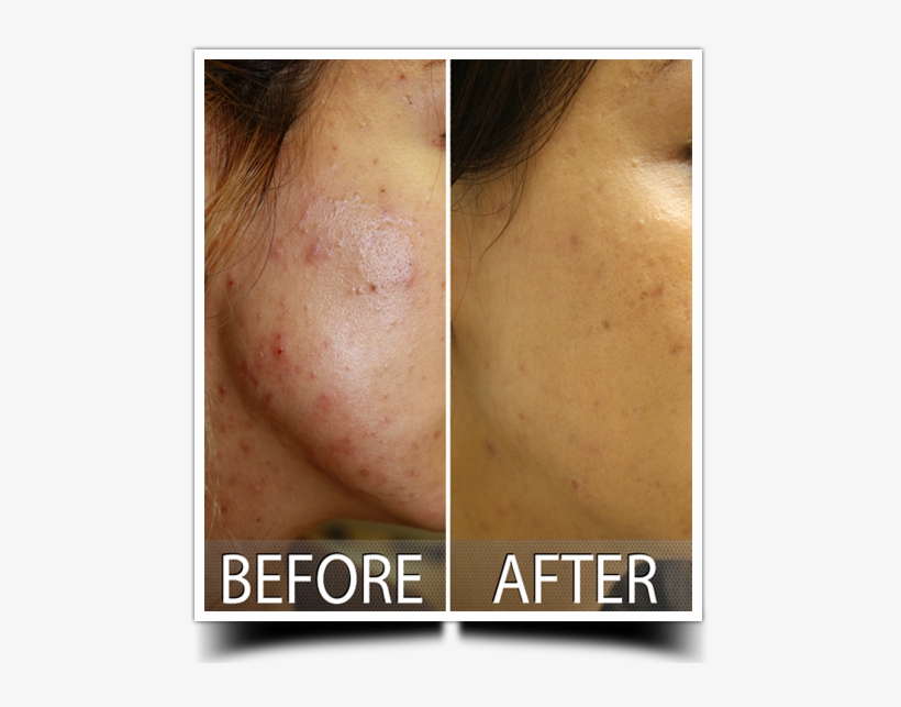 Laser Acne - Freckle, transparent png download