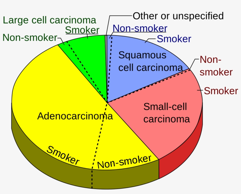 Types Non Small Cell Lung Cancer - Most Common Lung Cancer, transparent png download