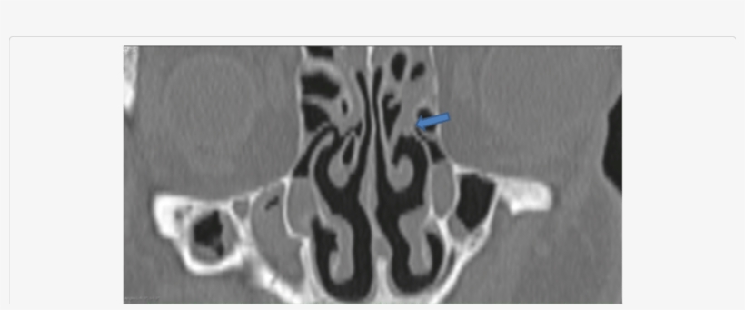 Uncinate Process Adheres With Middle Concha In Left - Ethmoidal Infundibulum, transparent png download