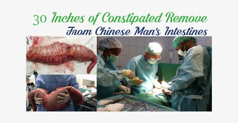 30 Inches Of Constipated Remove From Chinese Man's - Does The Intestines Look With Constipation, transparent png download