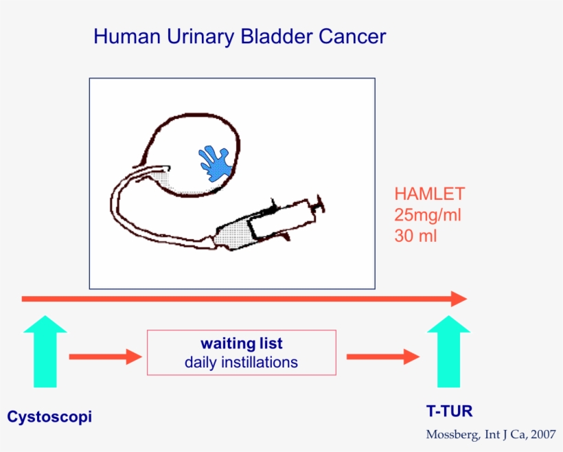 Human Urinary Bladder Cancer Treatment With Hamlet - Human, transparent png download