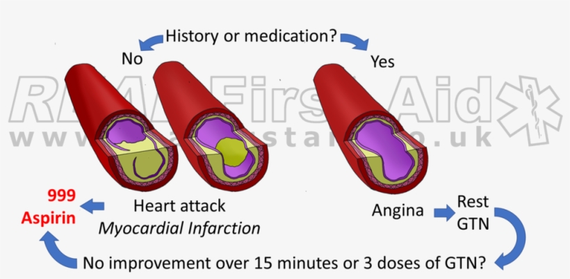 Chest Pain Treatment 2 Logo - Treatment In Heart Attack, transparent png download