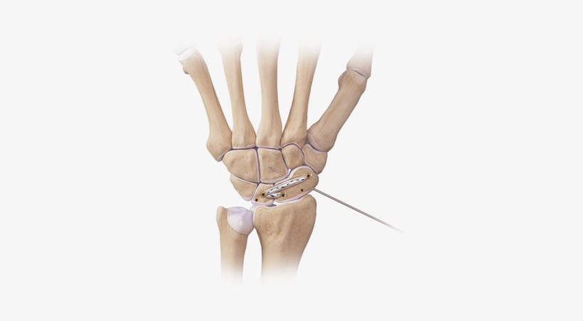 Hand And Wrist Scapholunate Repair Swivelock 0 Large - Arthrex Internal Brace Scapholunate, transparent png download