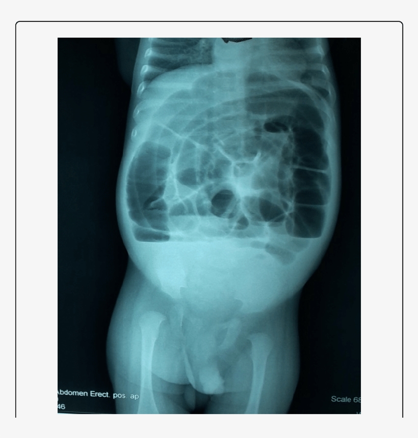 X Ray Image Examination Showing Multiple Air Fluid - X-ray, transparent png download