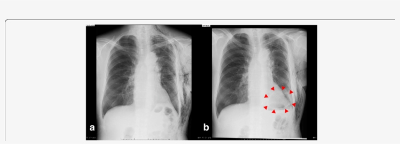 A Chest X-ray On Pod7 Reveals No Dead Space In The - Lung, transparent png download