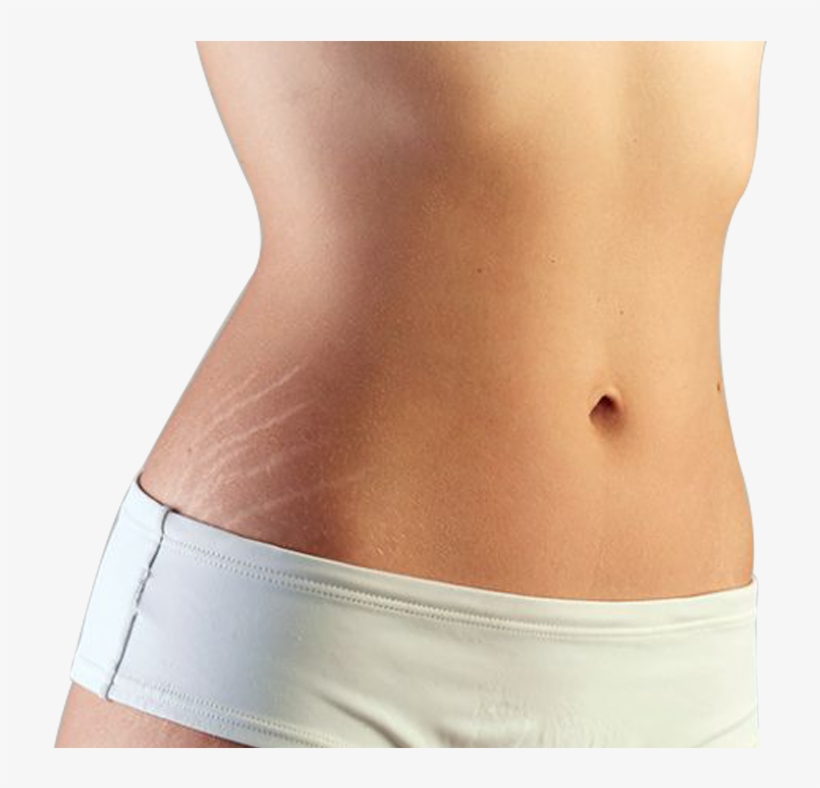 Stretch Marks, transparent png download