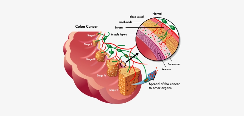 Approximately 150,000 New Cases Of Colorectal Cancer - Colon Cancer Stages, transparent png download