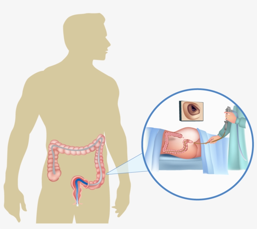 A Colonoscopy Is A Procedure That Examines The Colon - Colorectal Cancer, transparent png download