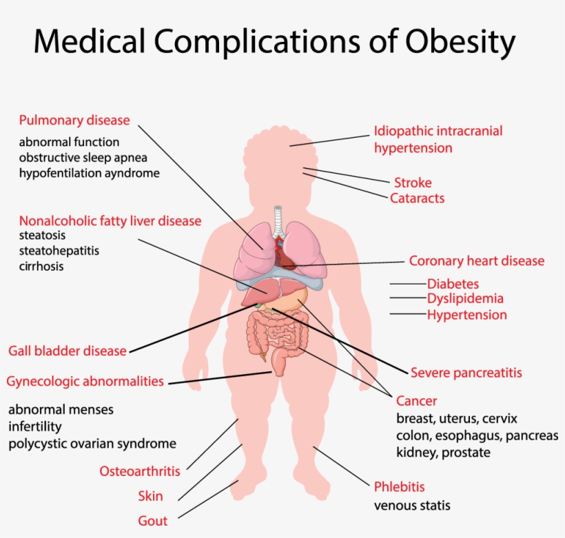 Medical Complications Obesity - Medical Obesity Complication, transparent png download
