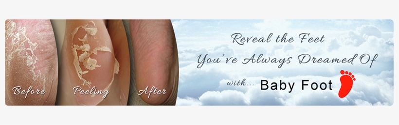 In Addition, Baby Foot Can Improve Other Foot Issues - Glysolid Before And After, transparent png download