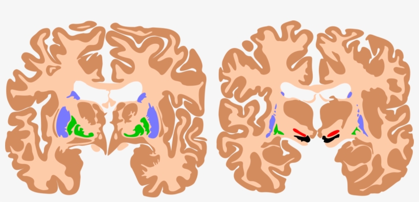 Spastic Cerebral Palsy Brain, transparent png download