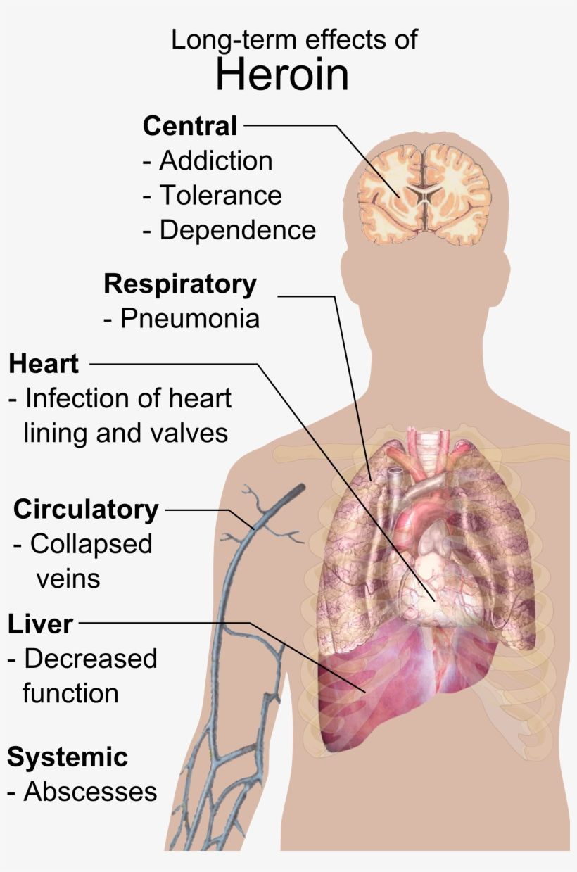 Long-term Effects Of Heroin - German Research Centre For Artificial Intelligence, transparent png download