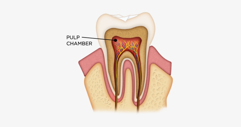 A Root Canal Is A Treatment That Simply Cleans Out - Endodoncia, transparent png download