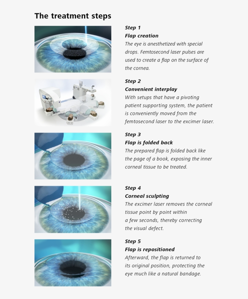Image - Steps Of Lasik Procedure, transparent png download