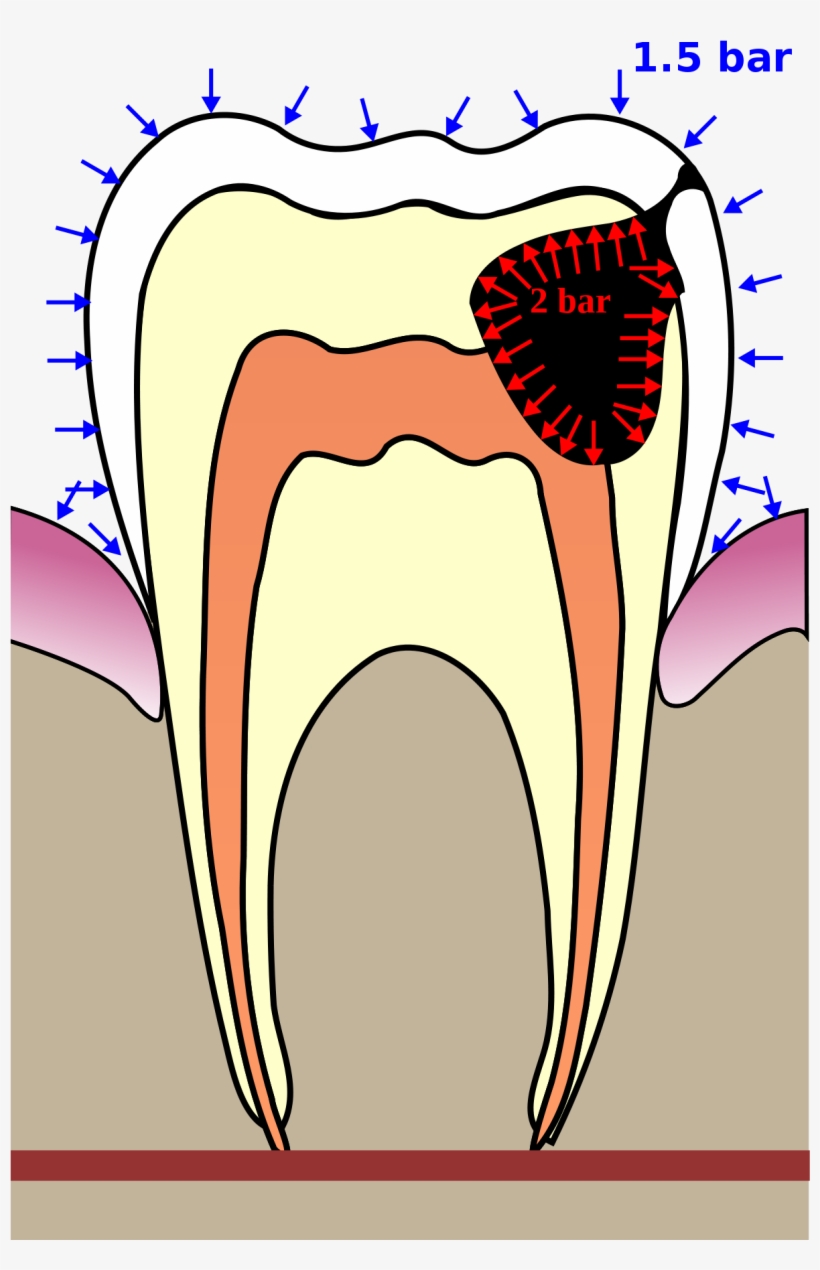 Barotraumatisme Dentaire, transparent png download