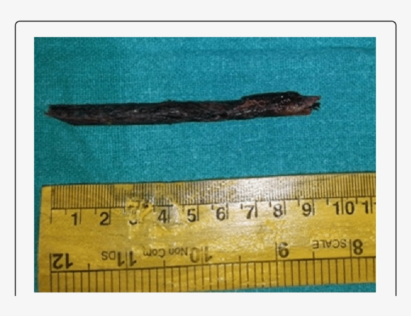 Removed Wooden Foreign Body Measuring - Centimetre, transparent png download