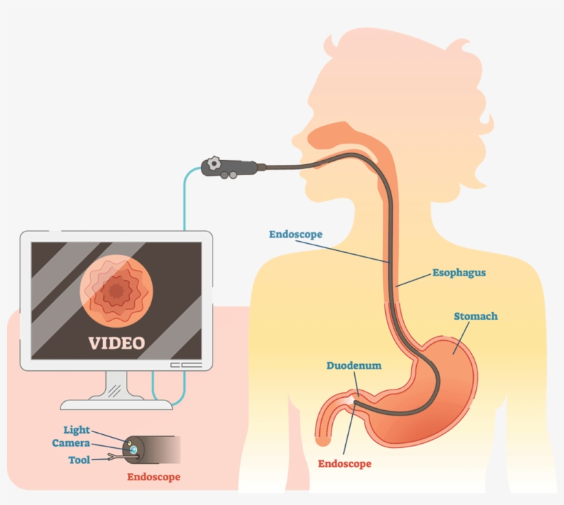 Endoscopic Ultrasound Or Eus Is An Advanced Endoscopic - Endoscopy Clipart, transparent png download