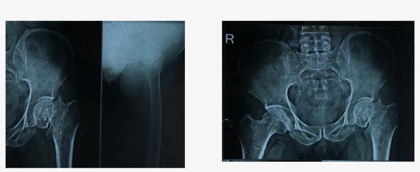 Neck Of Femur Fracture Secondary To Bone Infarcts Of - Femur, transparent png download