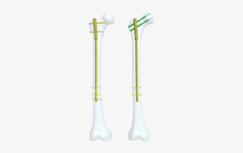 Femur Reconstruction Im Nail System - Intramedullary Rod, transparent png download
