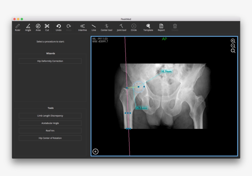 Femoral, Acetabular And Combined Offset - Scoliosis, transparent png download