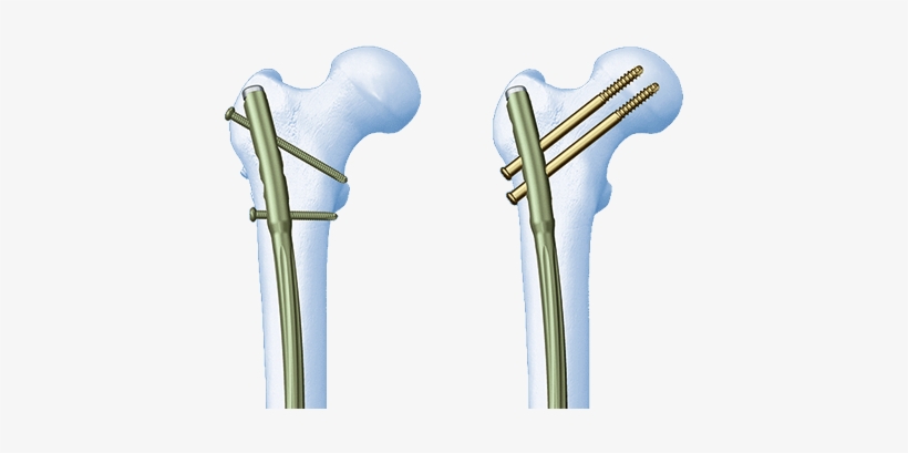 Choose - Lateral Femoral Nail, transparent png download