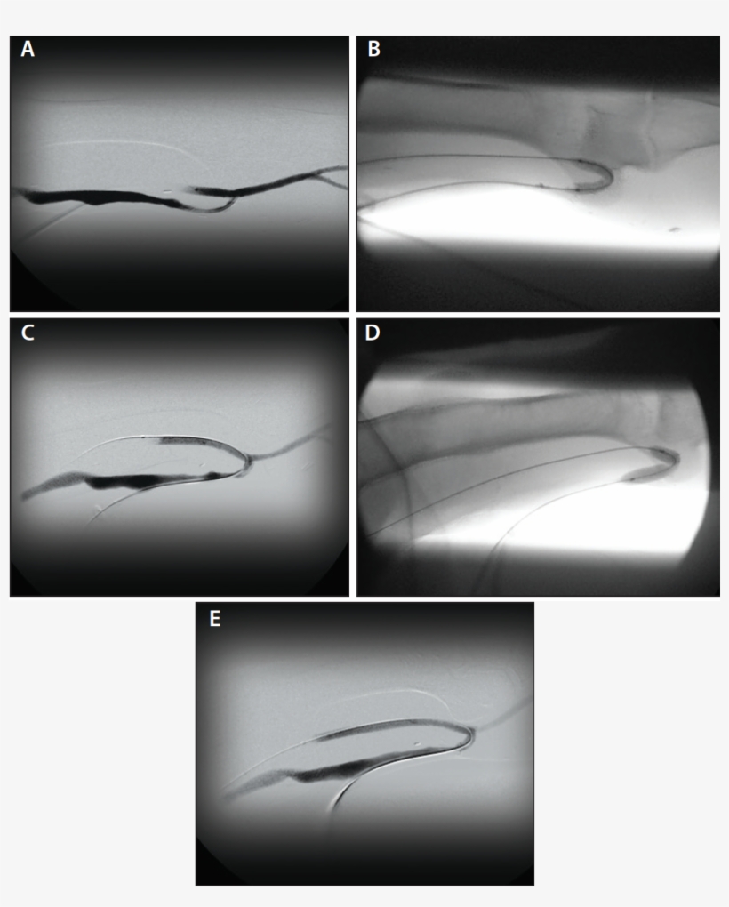 Figure 2 - - Fistula, transparent png download