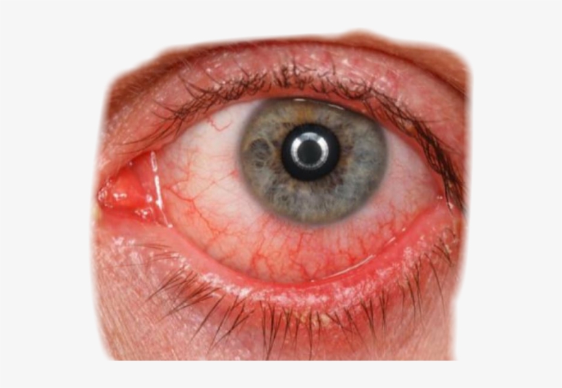 Eye Sticker - Eye Herpes, transparent png download
