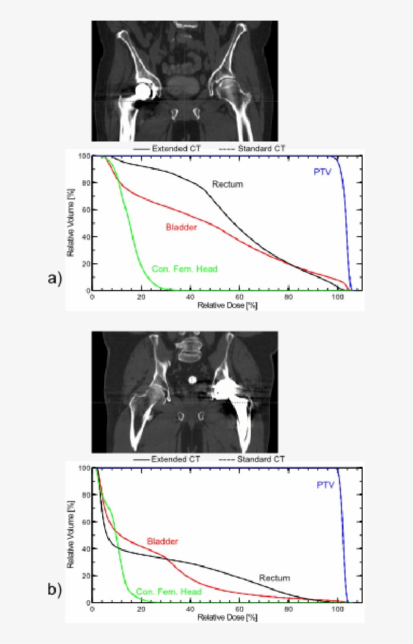 Anatomies And Corresponding Dvhs For Vmat Plans On - Diagram, transparent png download