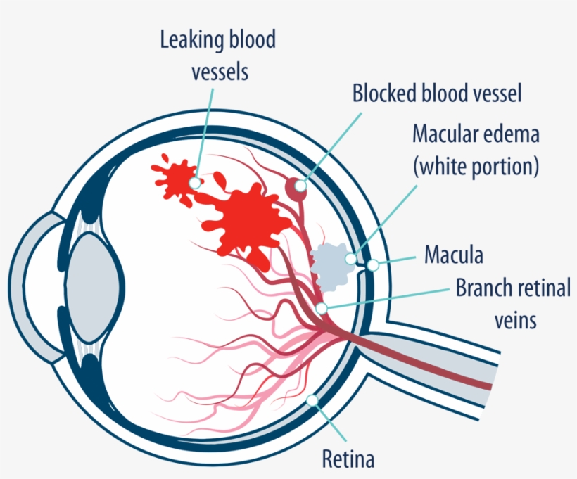 Eye With Macular Edema Following Retinal Vein Occlusion - Macula Of Retina, transparent png download