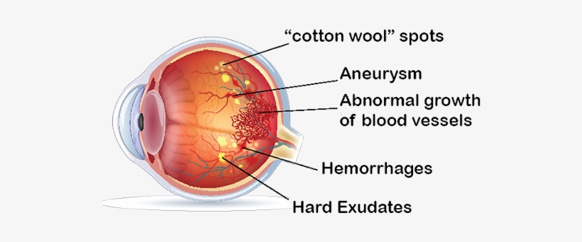 Diabetic Retinopathy - Cataract, transparent png download