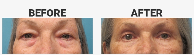 How To Get Rid Of Dark Circles Under Eyes - Close-up, transparent png download