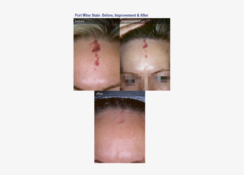 Before & After Photos - Pulsed Dye Laser Red Scar, transparent png download