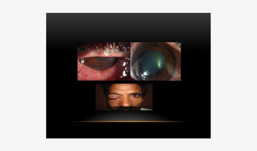 Right Eye Slit Photograph Shows Multiple Injection - Cornea, transparent png download