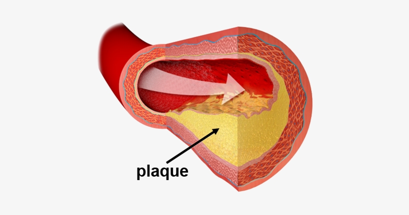 As A Conscientious Medical Practitioner, Dr - Damaged And Narrowed Arteries, transparent png download