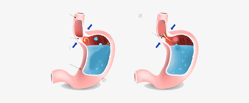 Gasteroesophageal Reflux Disease - Gerd Symptoms, transparent png download