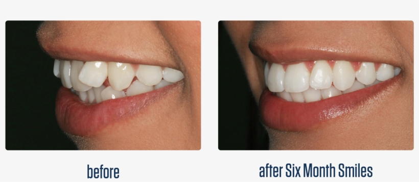 Six Month Smiles Before And After Photo - Before And After Six Month Smiles, transparent png download