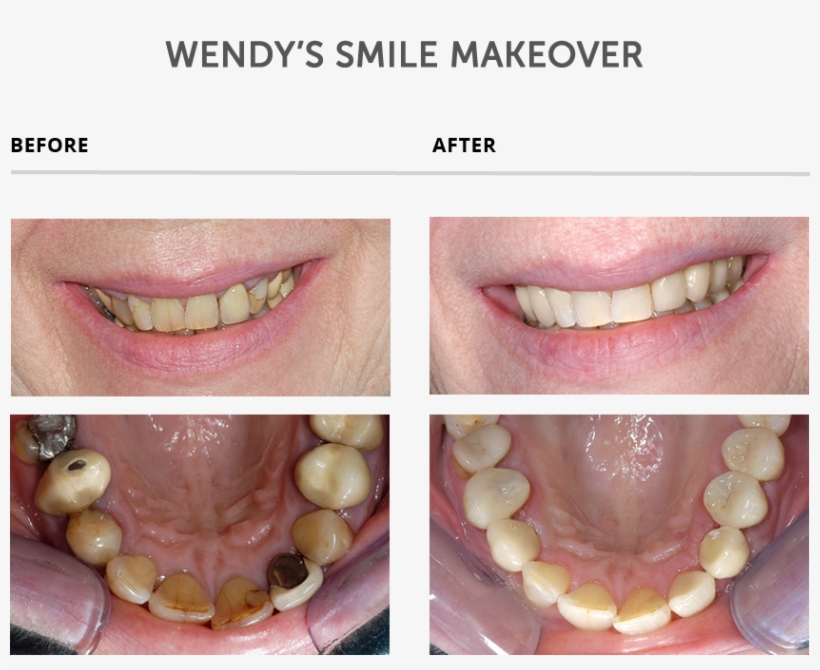 Weybridge Teeth Smile Makeover - Teeth Makeover, transparent png download