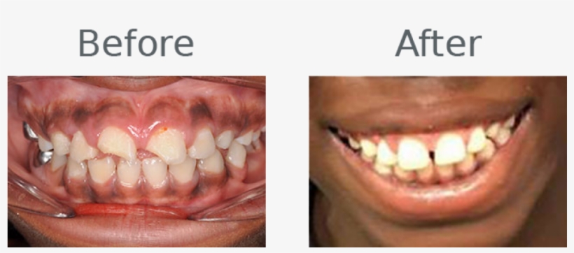 Luckily, This Student's Mouth Was In Good Shape, And - Cosmetic Dentistry, transparent png download